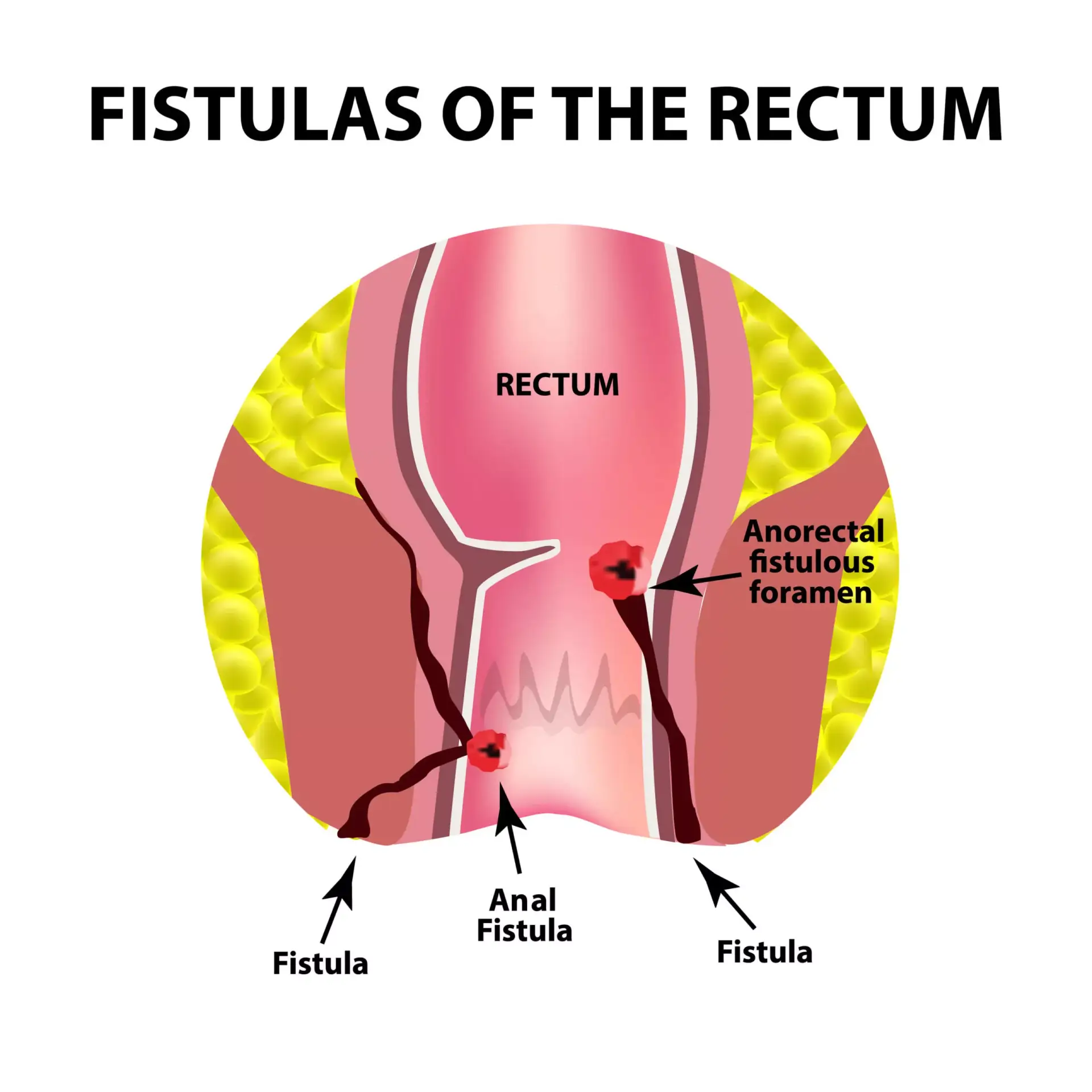 Anal Fistula Treatment illustration