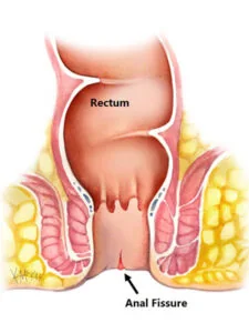 Anal Fissure Treatment illustration
