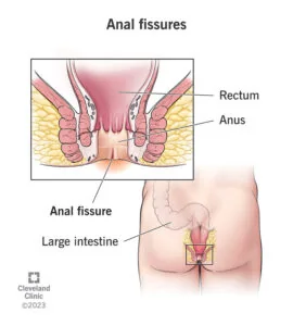 Anal Fissure Treatment medical illustration