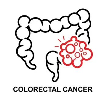 Colon Cancer Treatment illustration