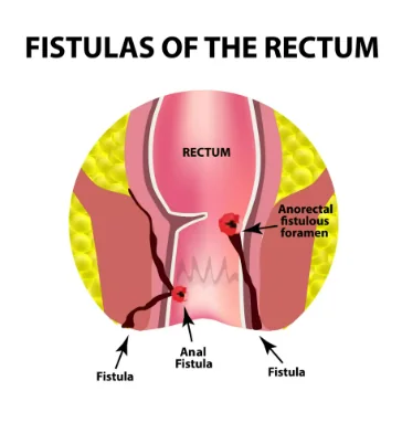 Fistula Operation illustration