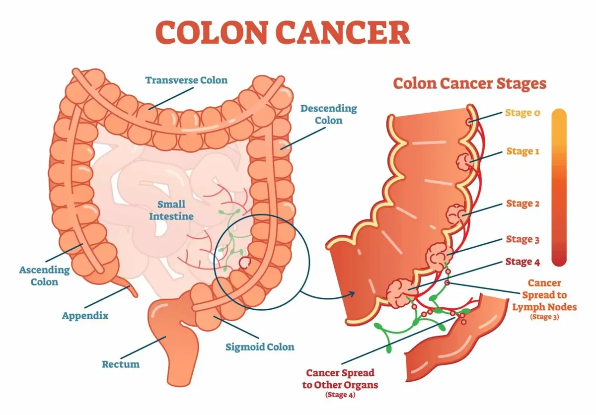 Colon Cancer Symptoms in Bangladesh