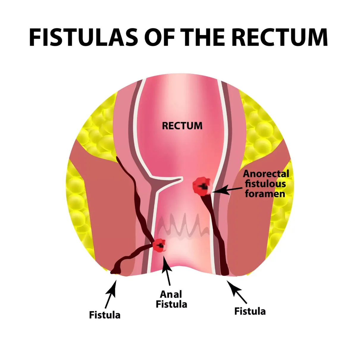 Fistula Operation Recovery