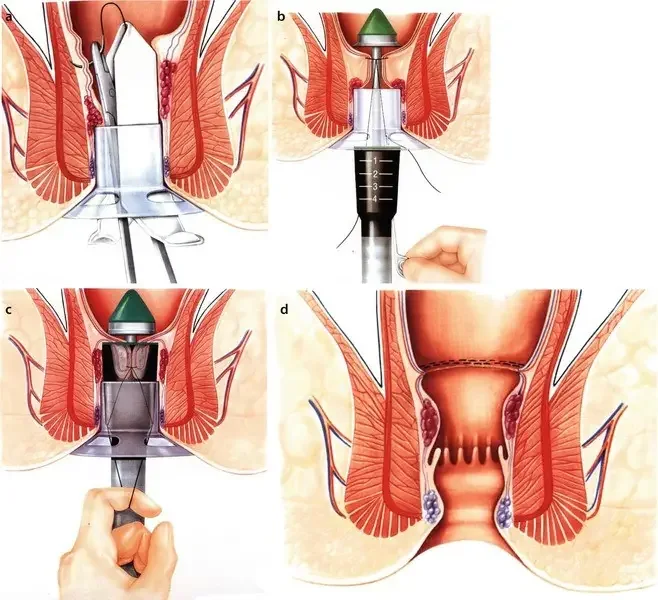 Longo Operation medical illustration