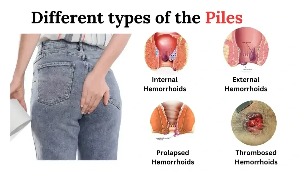 Piles Grades Explained: Symptoms and Treatment