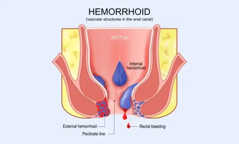 Piles Treatment illustration